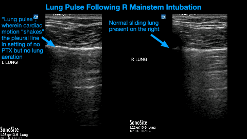 Lung sliding ultrasound — the artefact Greg's deep-learning model detects.